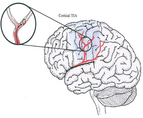 Carotid Artery Blockage. carotid artery blockage surgery, carotid ...